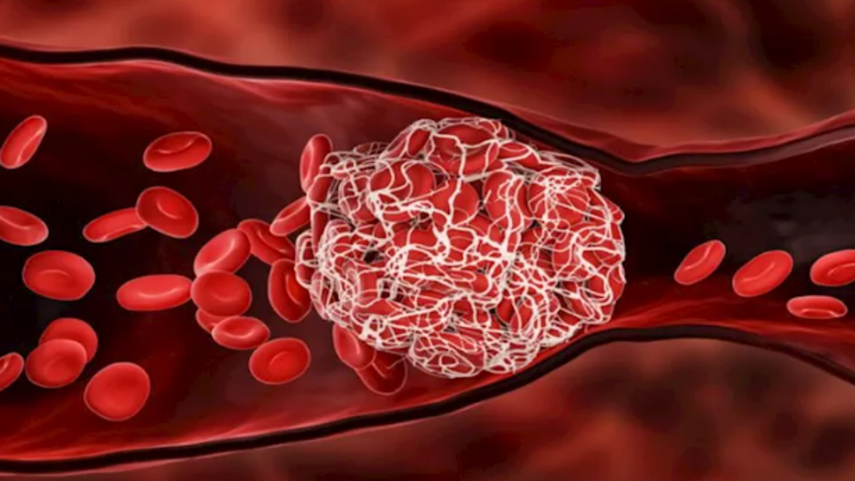 Expert shares 10 tips to reduce risk of blood clots