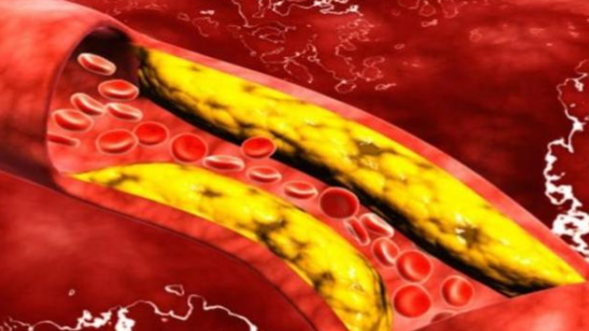 US heart institute outlines triglyceride symptoms and treatments