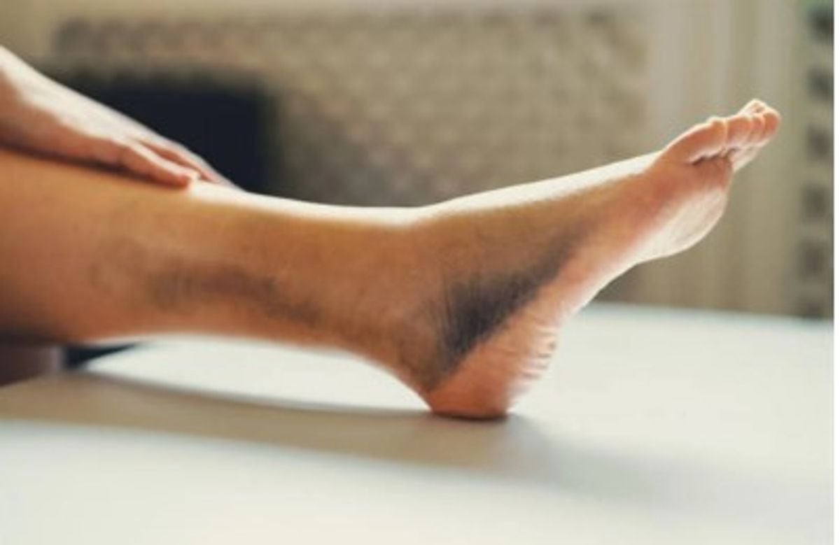 Doctor offers tips to prevent leg clots on long trips