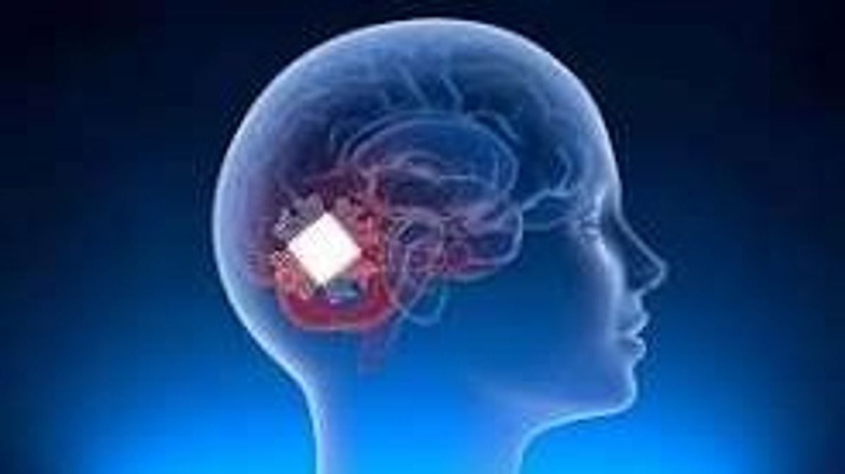 New brain chip aids speech and swallowing recovery after injury