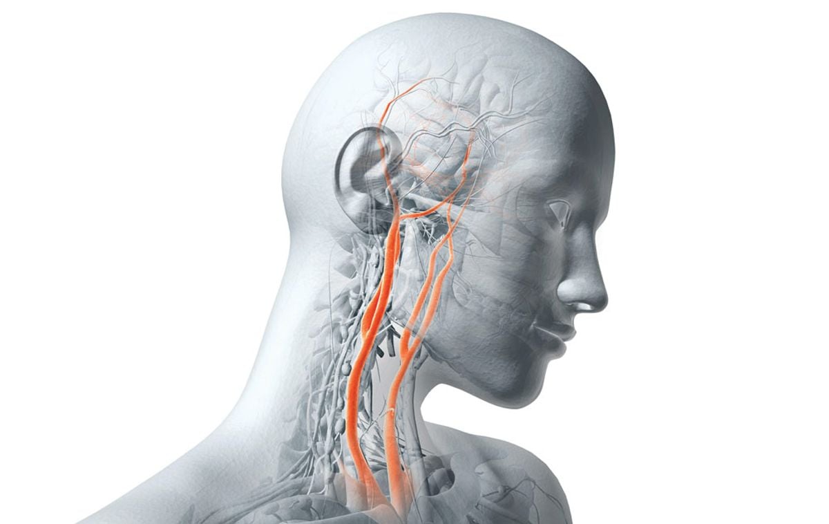 US researchers develop AI tool for early stroke detection during sleep