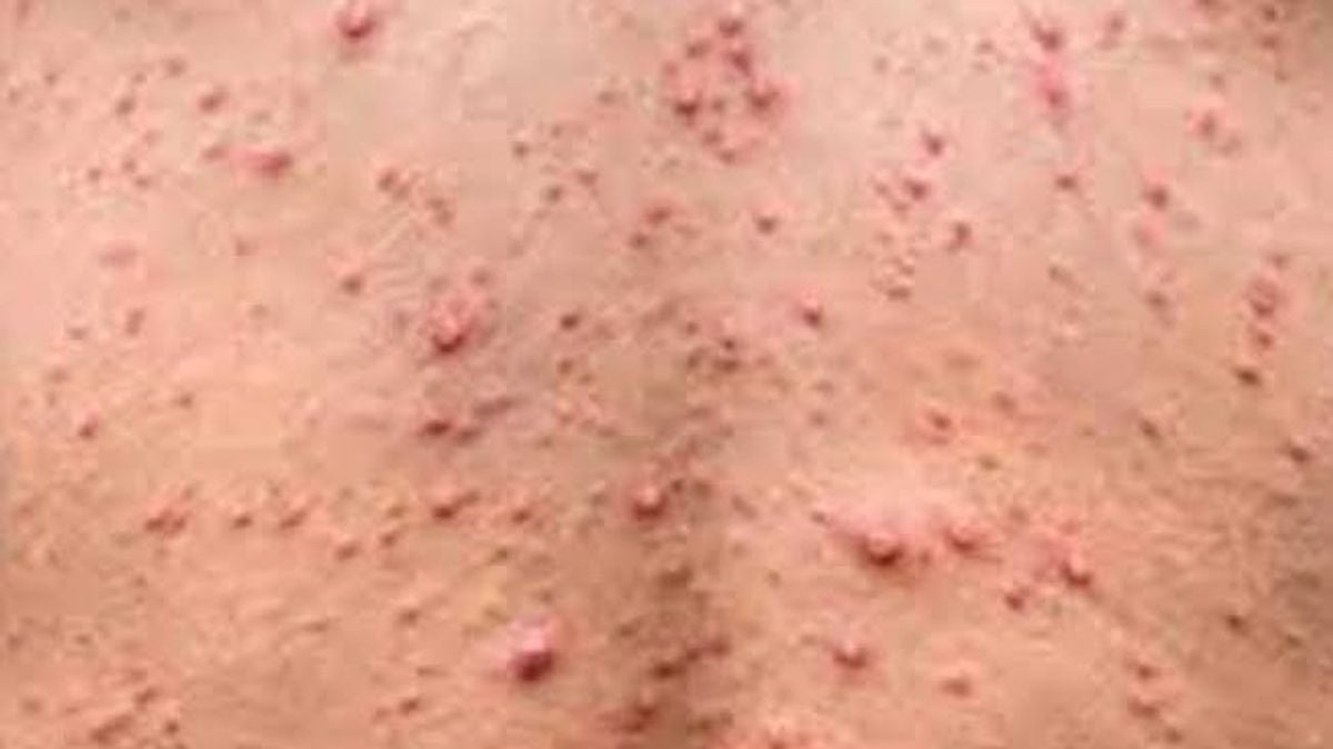 Pakistan reports four new monkeypox cases, total rises to 18