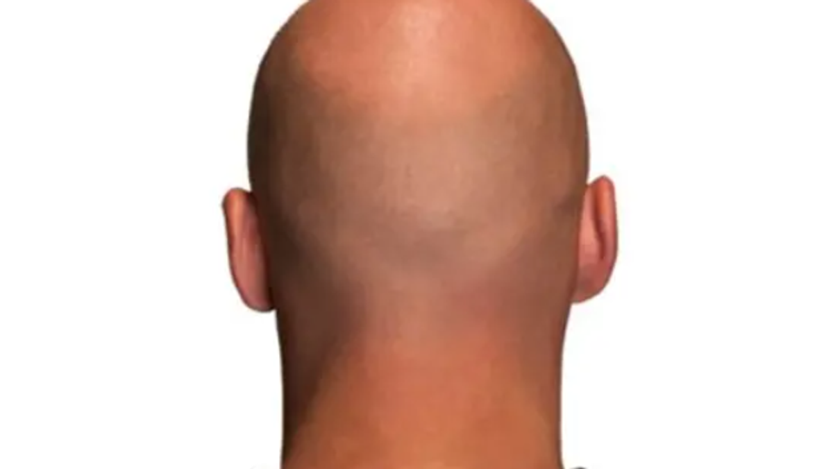New oral drug shows promise for male pattern baldness in 6 months