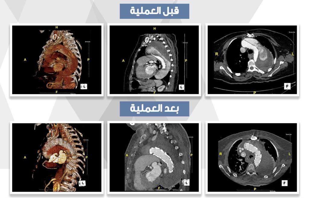 <div class="paragraphs"><p>عملية معقدة للقلب والشريان</p></div>