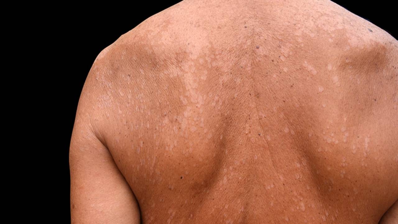 أسباب الإصابة بـ«النخالية المبرقشة» وطرق علاجها