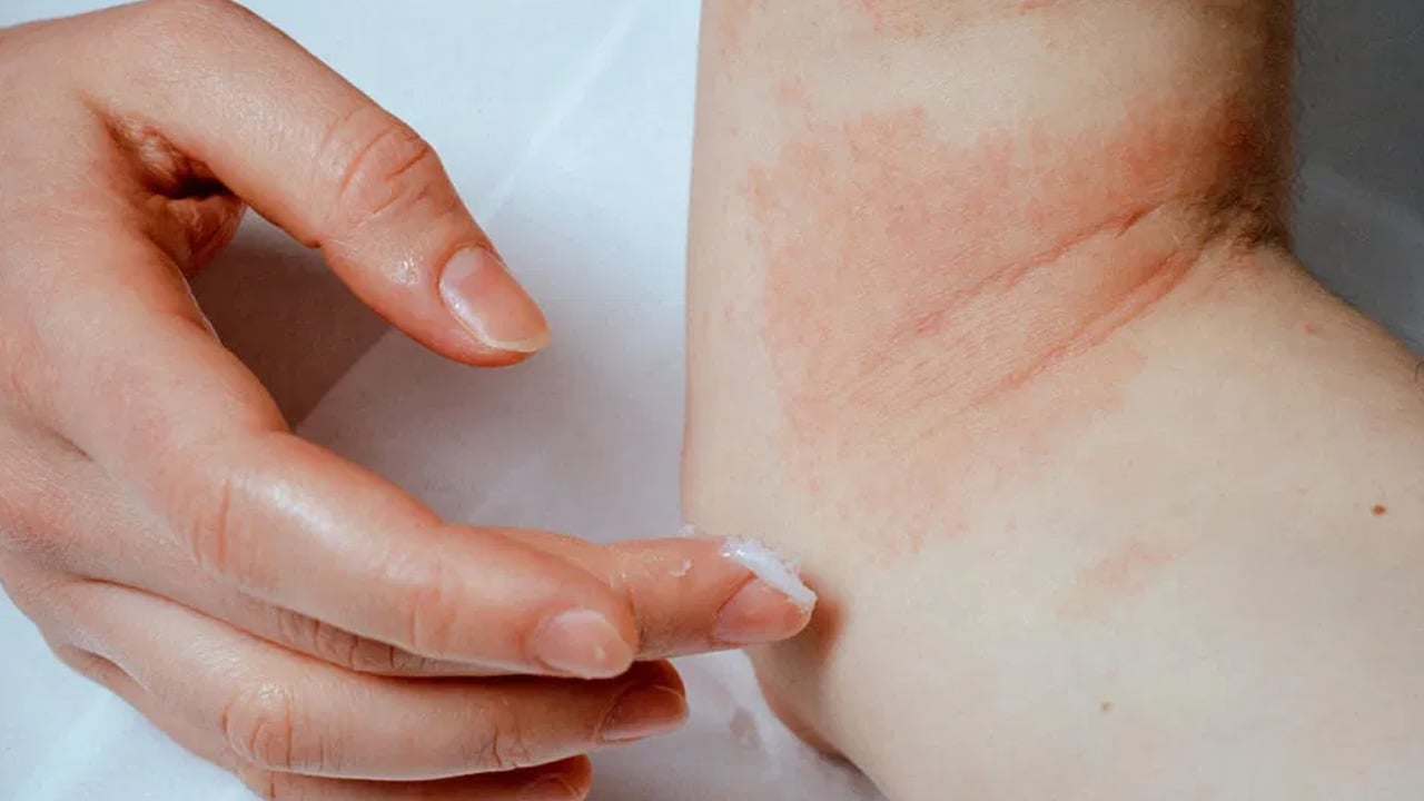نوعان لـ«الإكزيما» وهذه طرق العلاج
