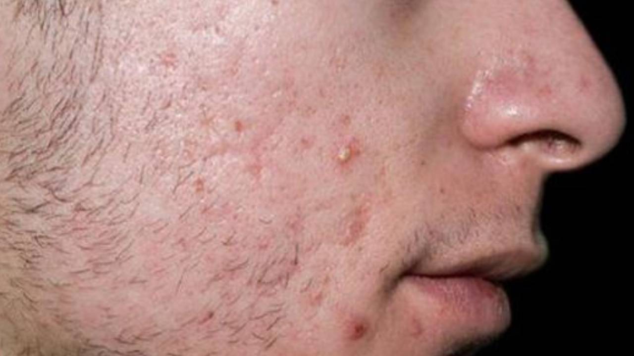 تُفاقم حب الشباب.. 5 أضرار للخلطة الثلاثية لتبييض البشرة
