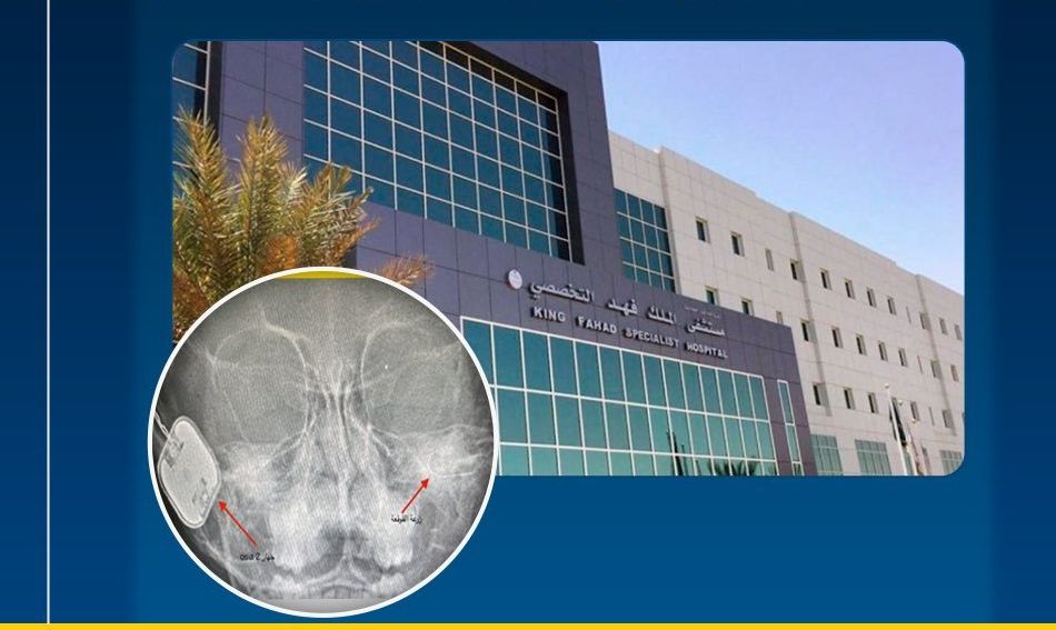 الأولى من نوعها بأوروبا والشرق الأوسط.. إجراء عملية نادرة لأذن طفلة بتبوك