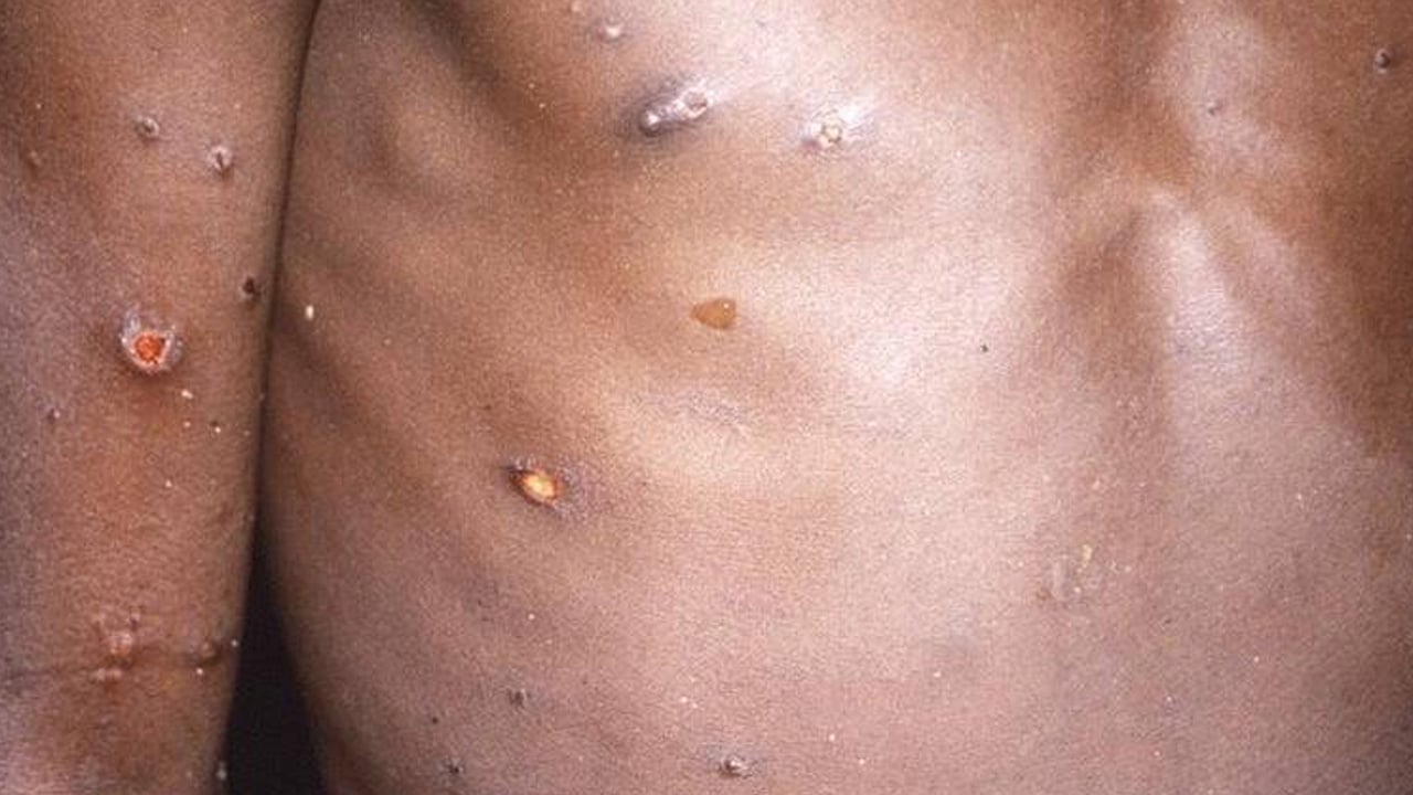 إسبانيا.. اشتباه في بؤرة عدوى بجدري القرود بـ«حفلات للمثليين»

