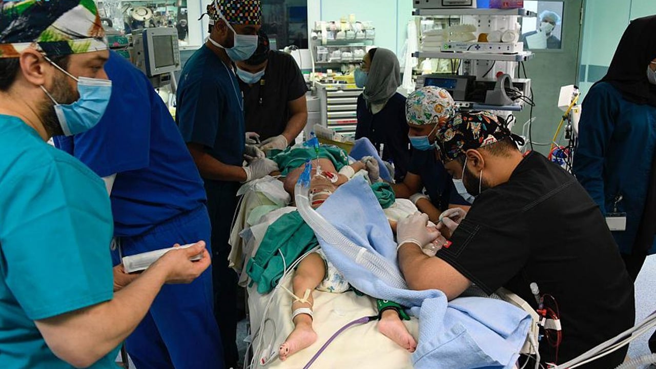 الفريق الجراحي لفصل التوأم اليمني الملتصق بالرأس يعلنُ وفاة أحدهما
