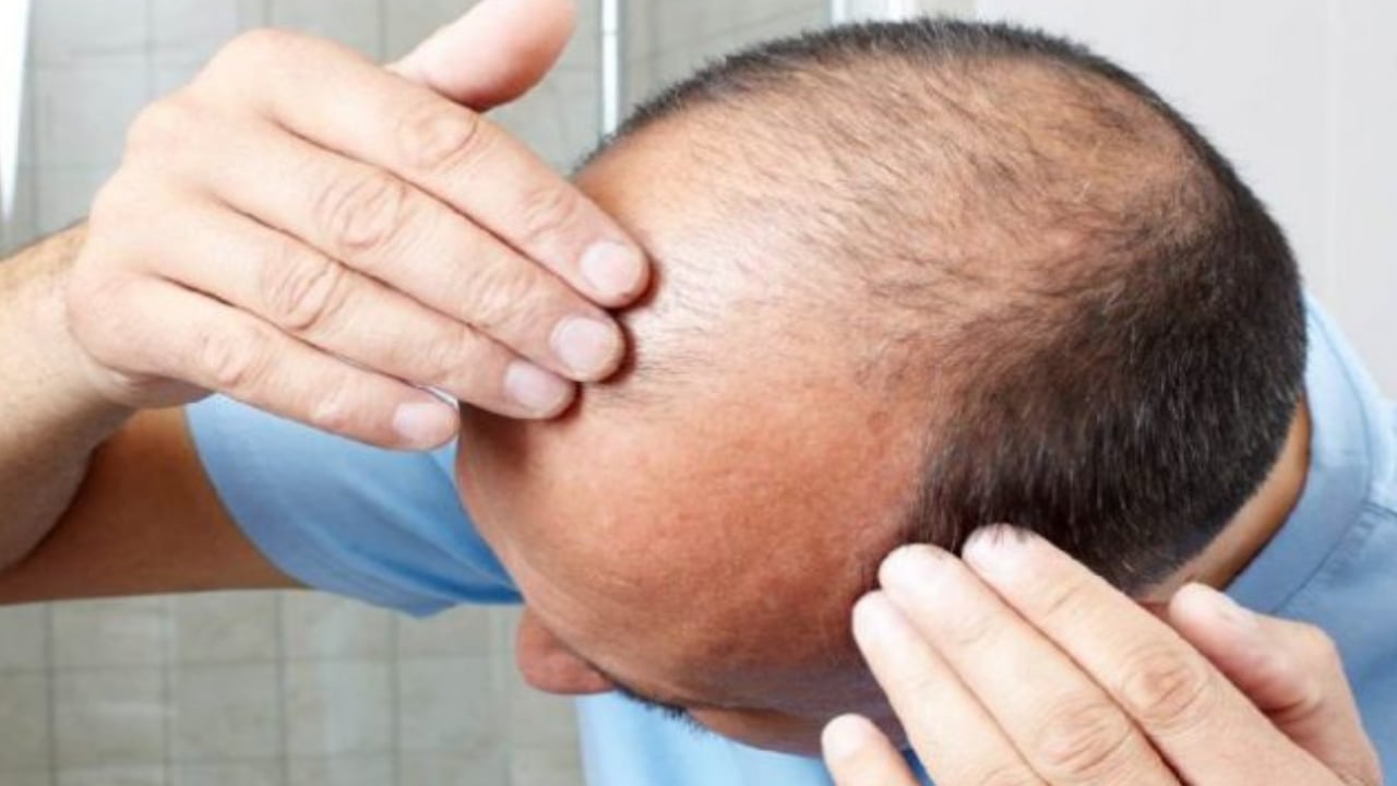 
أخصائية: خطر الوفاة نتيجة الإصابة بكورونا أعلى للرجال المصابين بالثعلبة