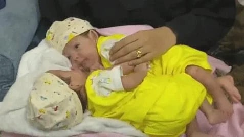 إنفاذًا لتوجيهات خادم الحرمين.. بدء عملية فصل التوأم السيامي اليمني «مودة ورحمة»