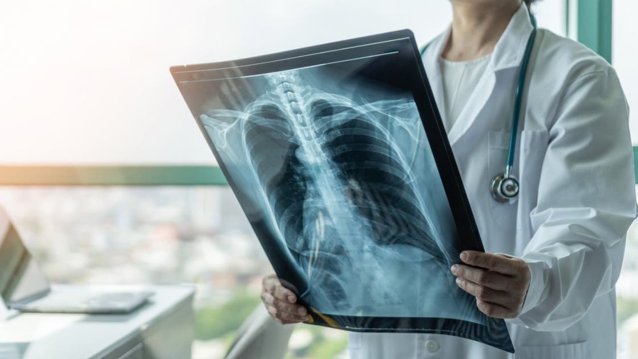 احذر.. هذه العلامات تكشف إصابتك بسرطان الرئة