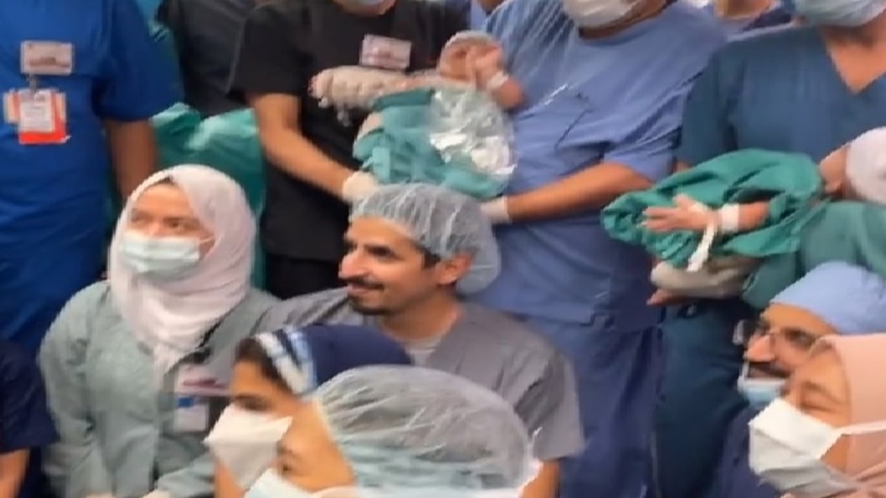 أول فيديو للتوأم السيامي اليمني «مودة ورحمة» بعد فصلهما

