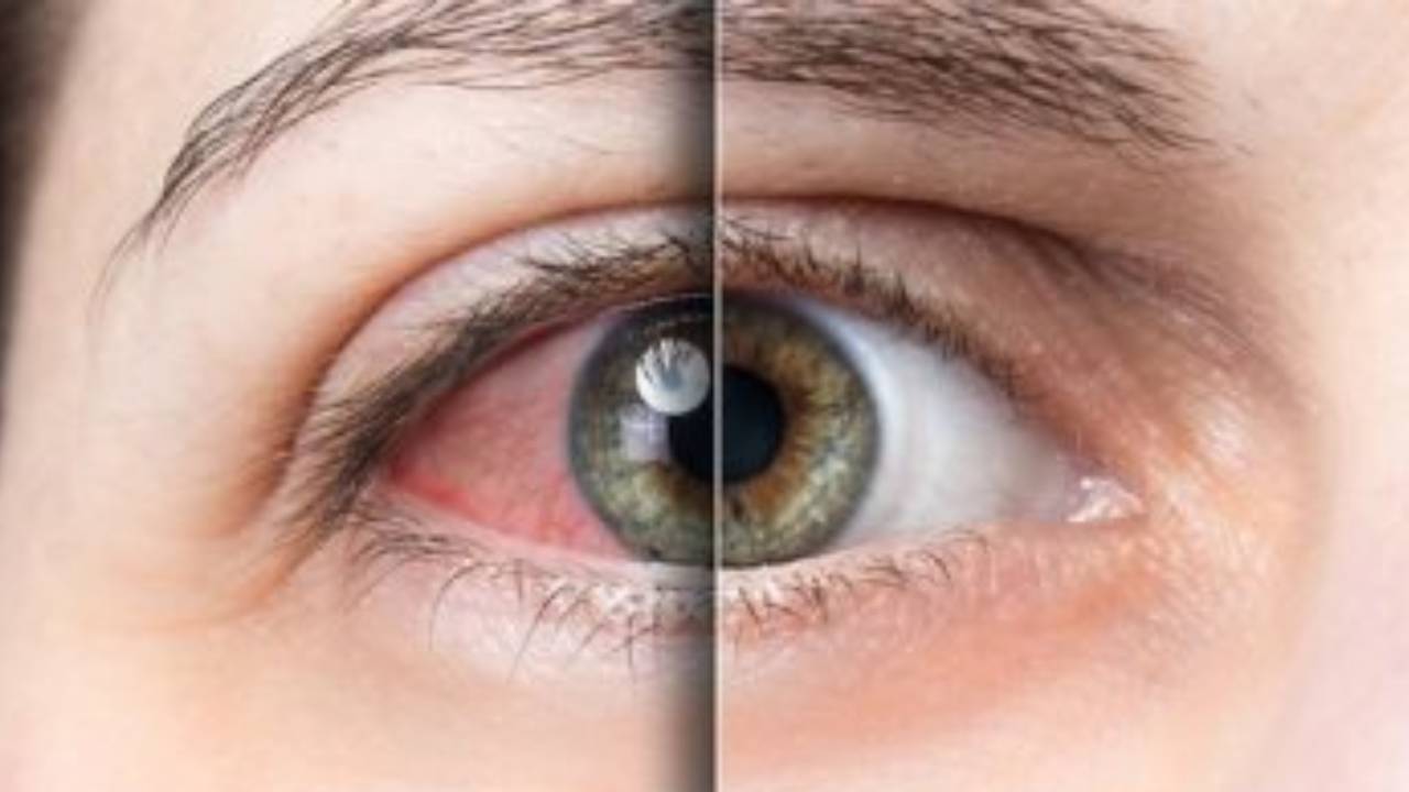 المخاطر والوقاية والعلاج.. 8 أسباب لمتلازمة جفاف العين 
