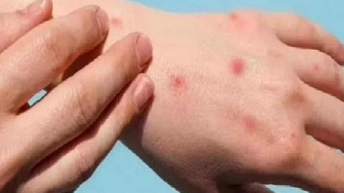 حالة نادرة في إيطاليا.. شخص يصاب بكورونا والإيدز وجدري القردة معًا
