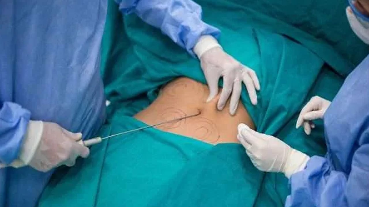 لأصحاب السمنة المفرطة.. استشاري يُحذر من فشل عملية قص المعدة 