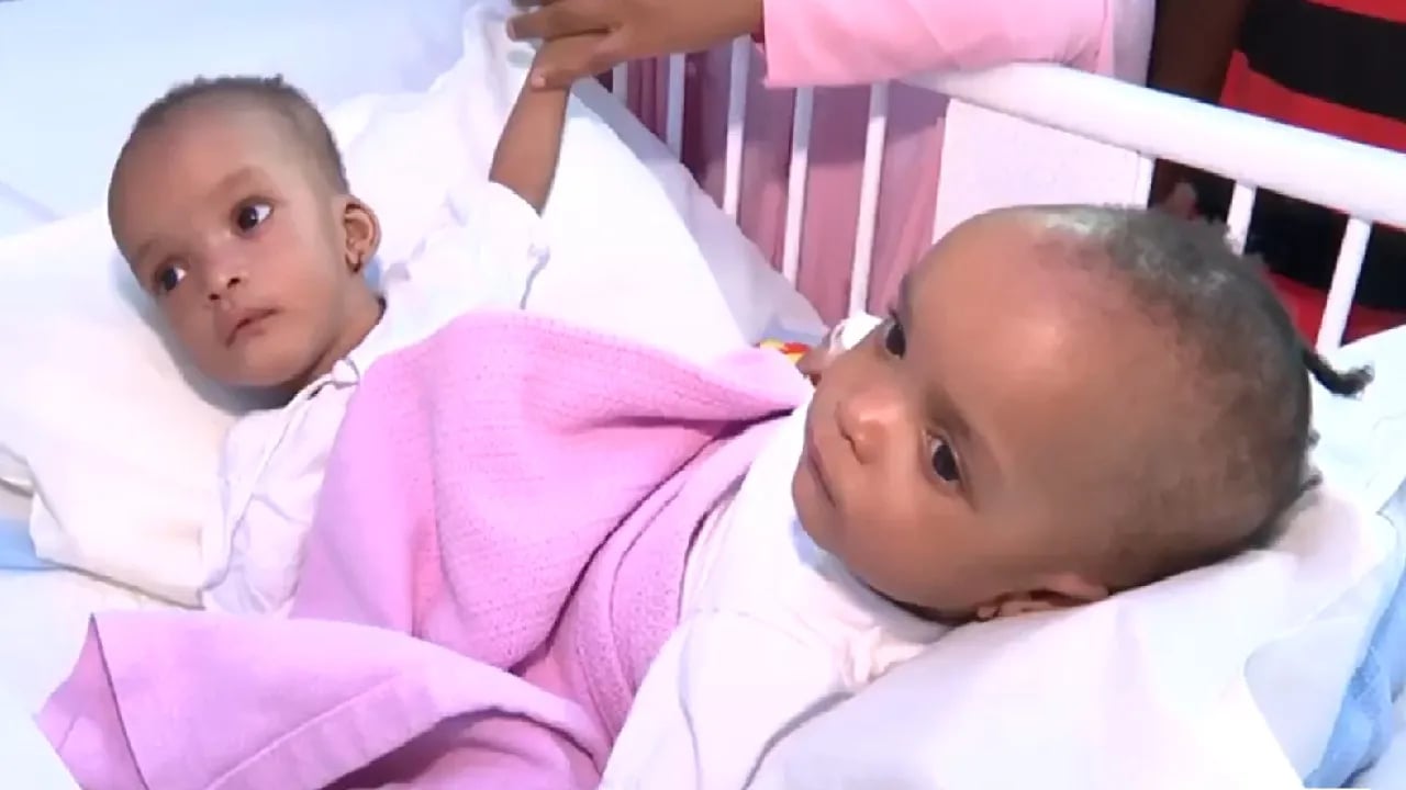 رئيس قسم جراحة الأطفال بمستشفى الملك عبدالله: الفحوصات الطبية الأولية للتوأم السيامي النيجيري جيدة