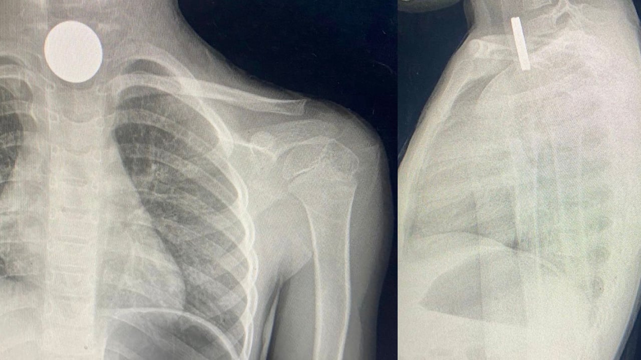 انقطع عنها الأوكسجين.. إنقاذ حياة طفلة ابتلعت قطعتين معدنيتين بطبرجل 