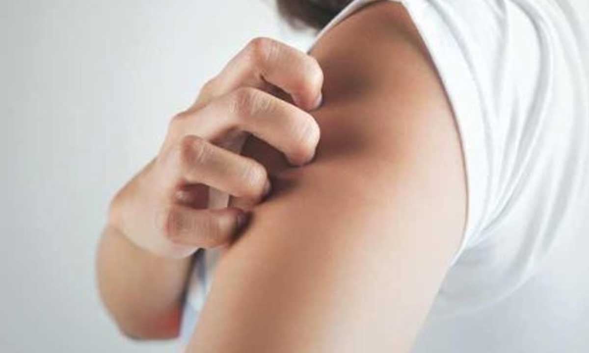 نصائح لمرضى الصدفية خلال فصل الشتاء