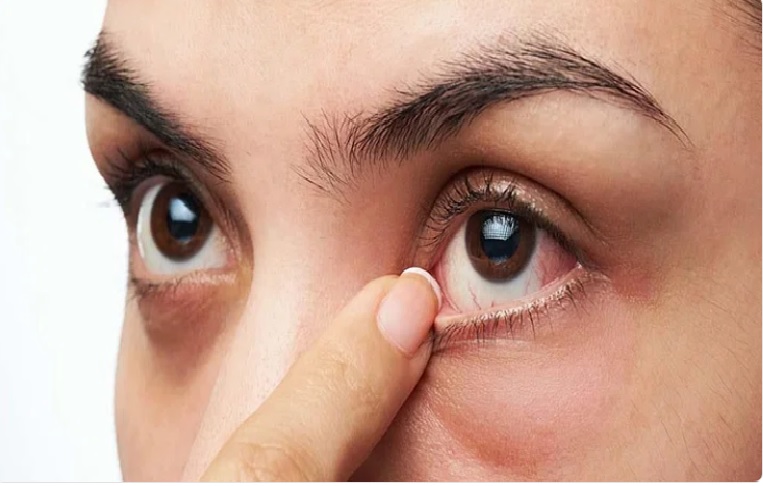أعراض جفاف العين وطرق علاجه