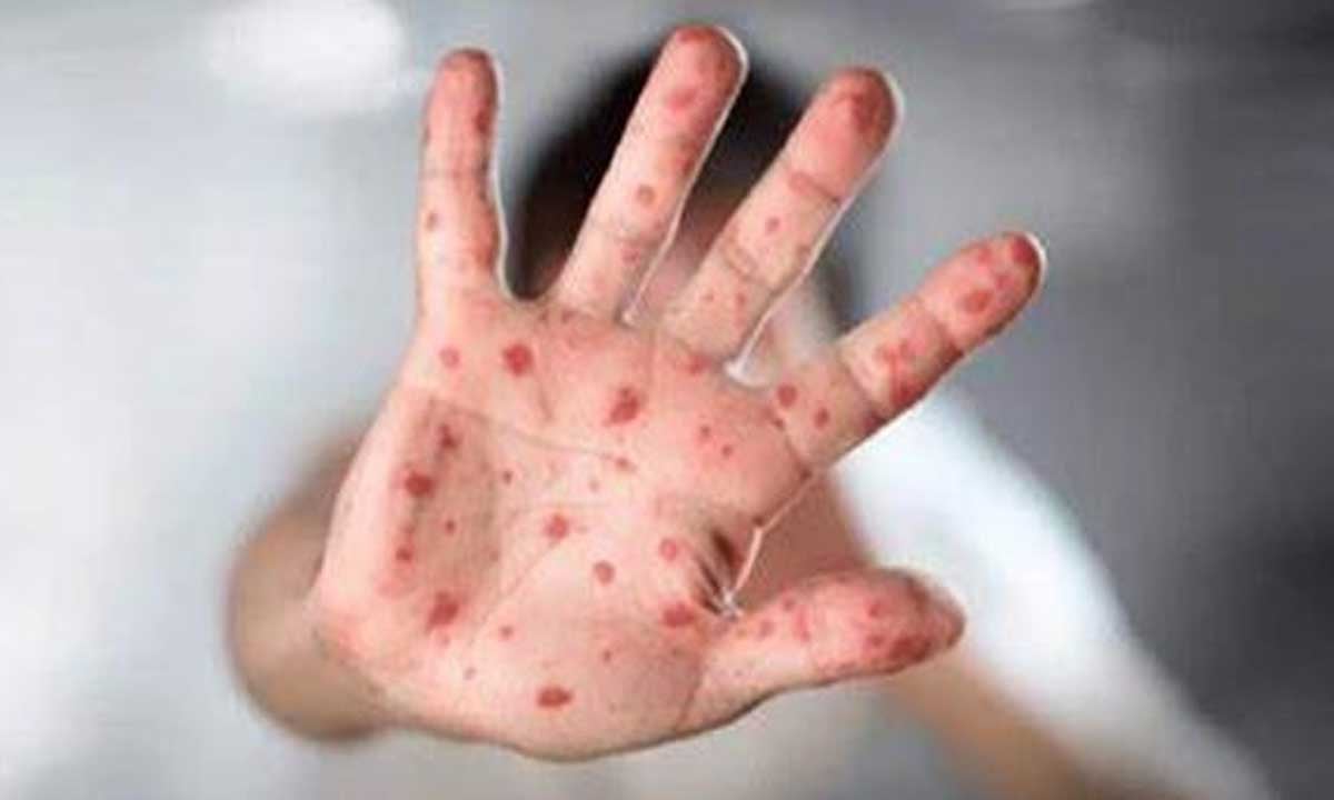  كوريا الجنوبية تسجل 3 إصابات جديدة بجدري القرود