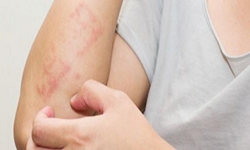 «الصحة» توضح طريقة التقديم على برنامج تأمين المواد الغذائية الخاصة بمرضى «السيلياك»