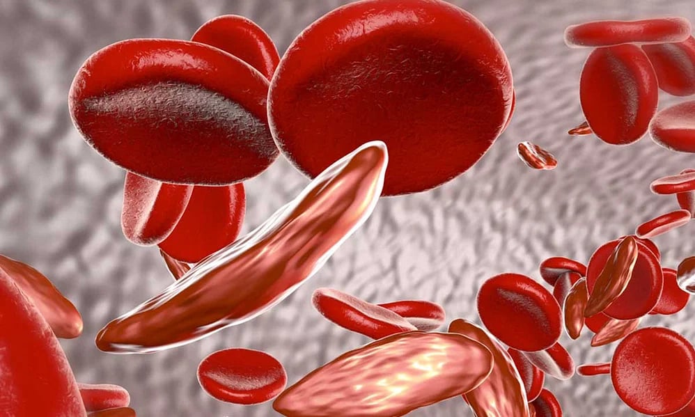 أسباب الإصابة بالأنيميا المنجلية وطرق الوقاية منه