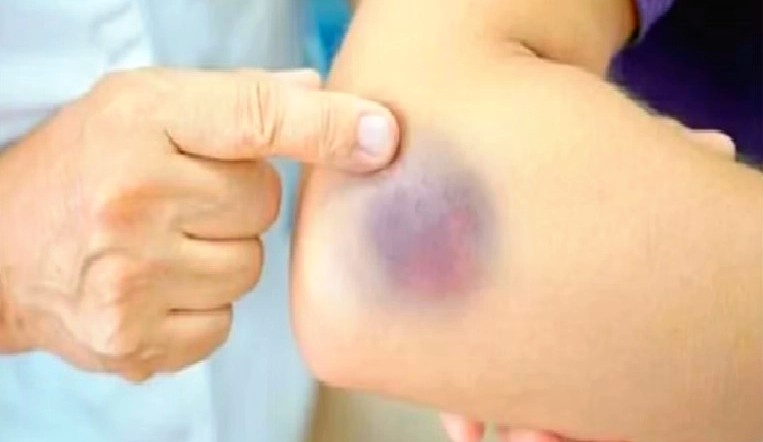 استشارية توضح أسباب وعلاج الكدمات أثناء فترة الحمل