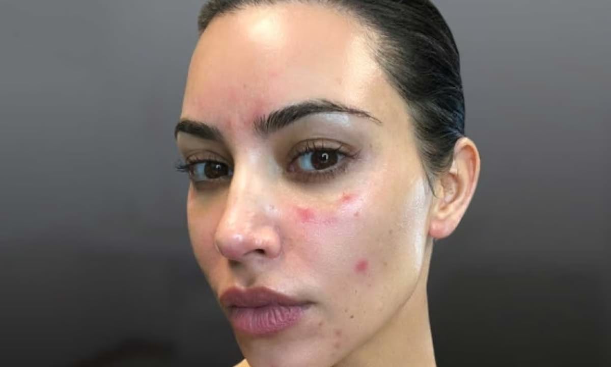 تجمع الرياض الصحي يوضّح أسباب الإصابة بمرض الذئبة الحمراء 