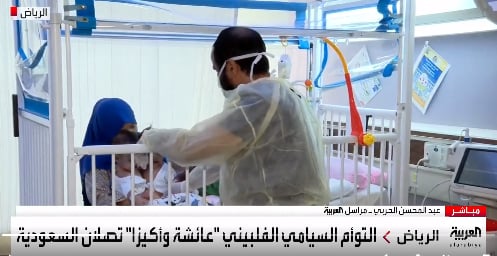 استشاري جراحة أطفال يكشف عن الوضع الطبي للتوأم السيامي الفلبيني

