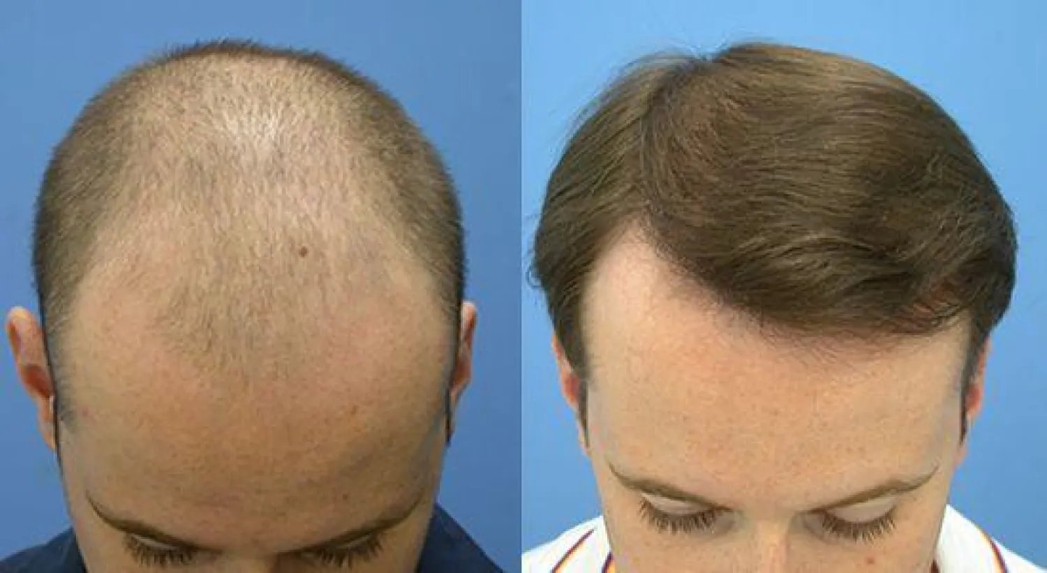تعرف على أفضل مراكز زراعة الشعر في السعودية| رام

