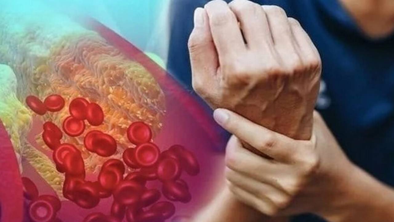 علامات على الأيدي تكشف الإصابة بارتفاع خطير للكوليسترول