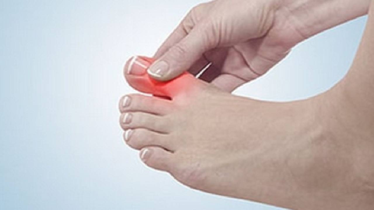 لمرضى النقرس.. احذروا تناول هذه الأطعمة