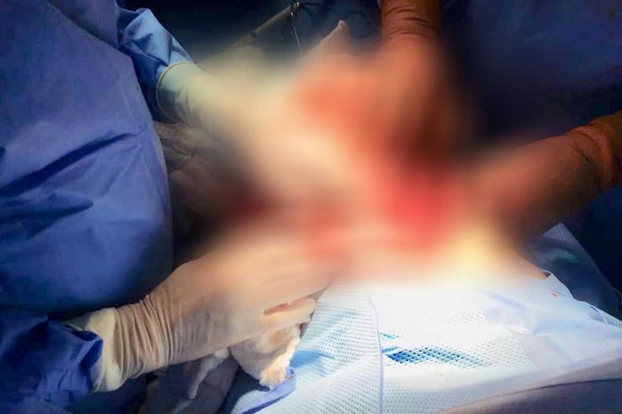إنهاء معاناة مريض بسبب انسداد في المعدة بمستشفى صامطة