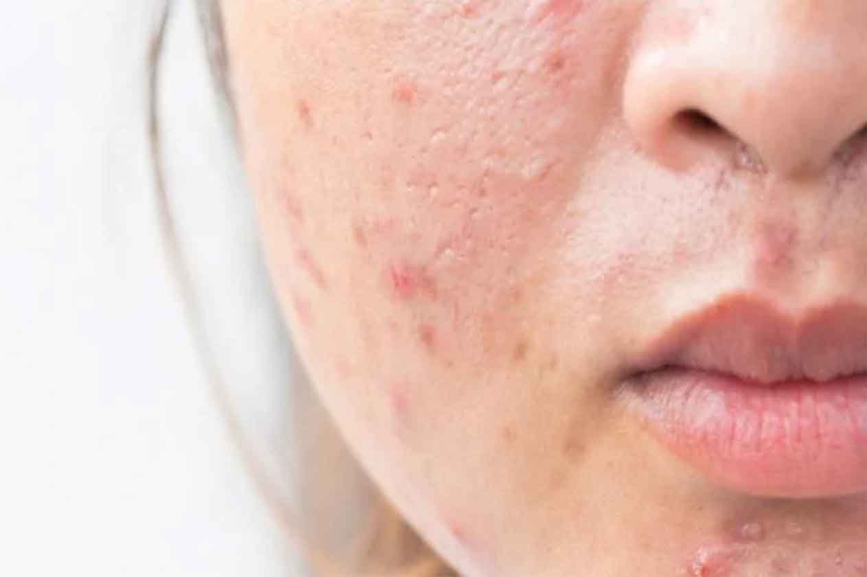 6 أطعمة يؤدي الإكثار منها إلى الإصابة بـ«حب الشباب»