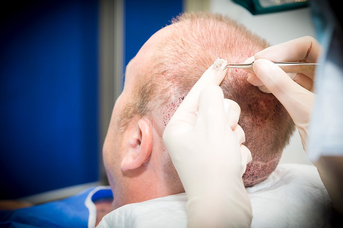 زراعة الشعر.. عمليات تُعيد الرونق للأشخاص ونتائجها مضمونة بشروط