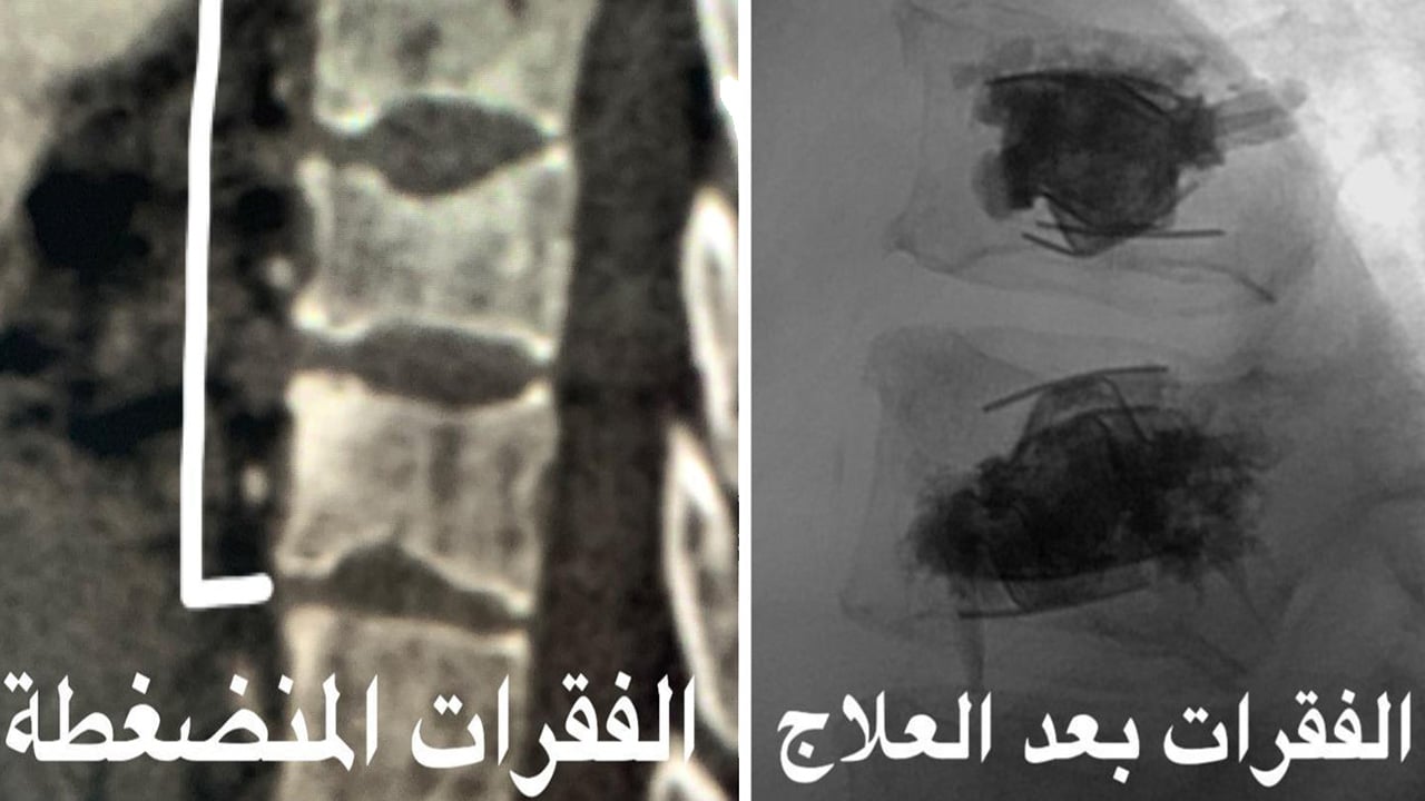 إنهاء معاناة ستينية بجراحة دقيقة في العمود الفقري