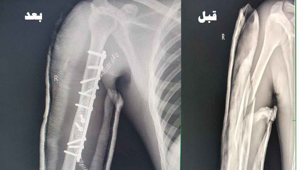 عملية ناجحة لشاب تعرض لكسر في حادث مروري بمستشفى الأسياح
