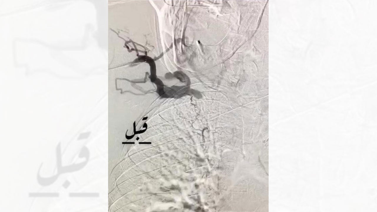 بسبب تورّم في الوجه.. عملية ناجحة لإنقاذ مريض عمره 99 عامًا
