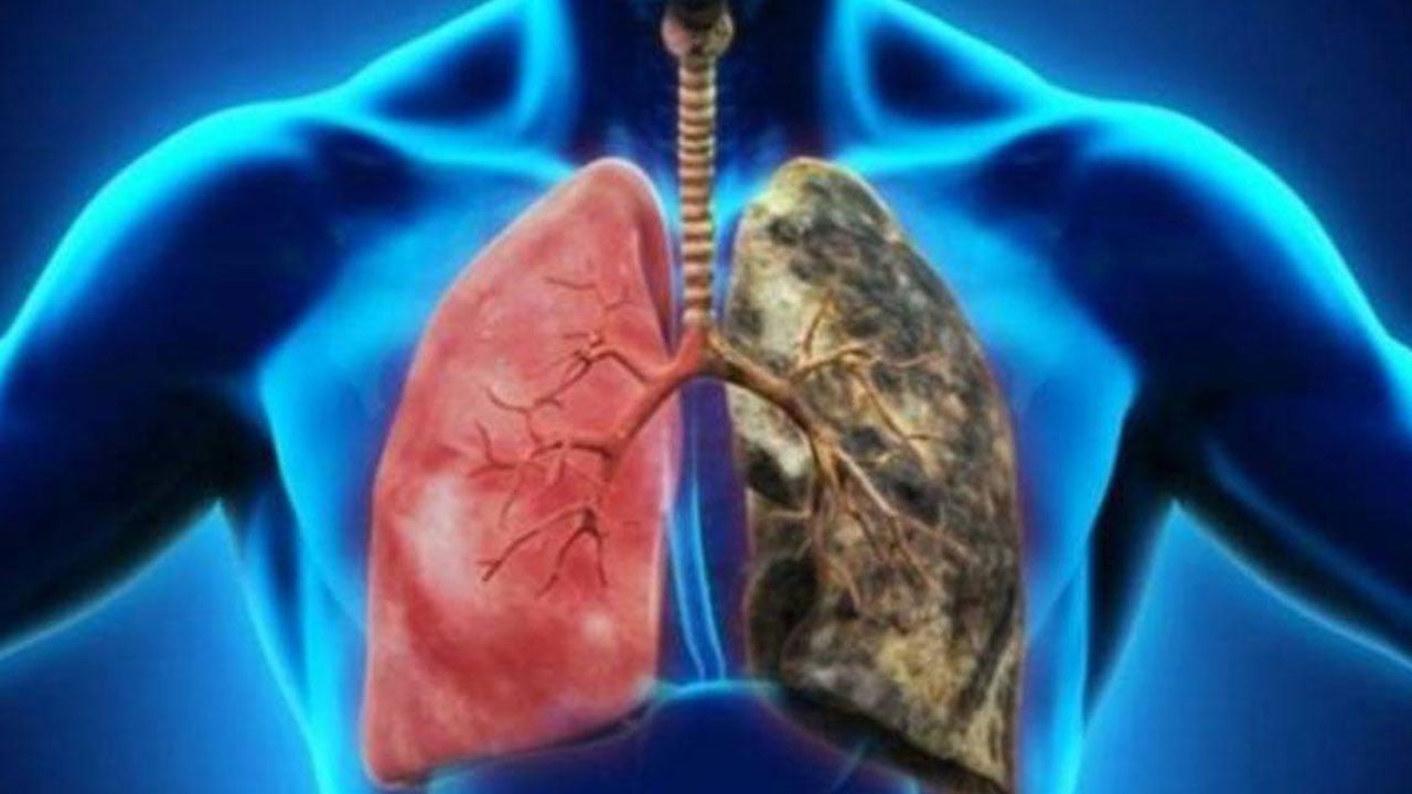 الانسداد الرئوي يُسبب 7 مضاعفات خطيرة .. احذر منها