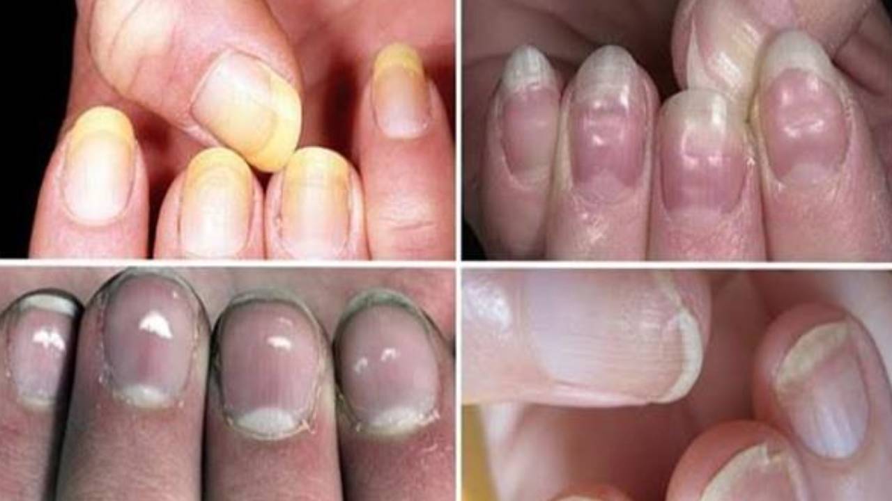 طبيب أورام يحذّر: 3 علامات في الأظافر تشير للإصابة بالسرطان
