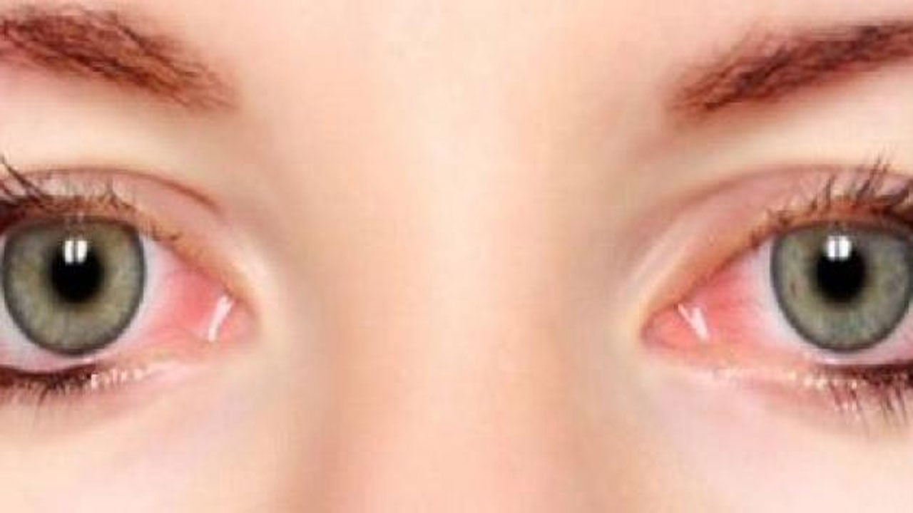 7 أسباب تؤدي إلى حرقان العين .. العدسات اللاصقة أحدها