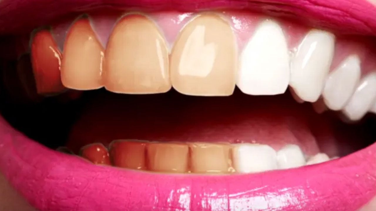 3 أطعمة تؤثر على لون الأسنان الطبيعي منها الكاتشب
