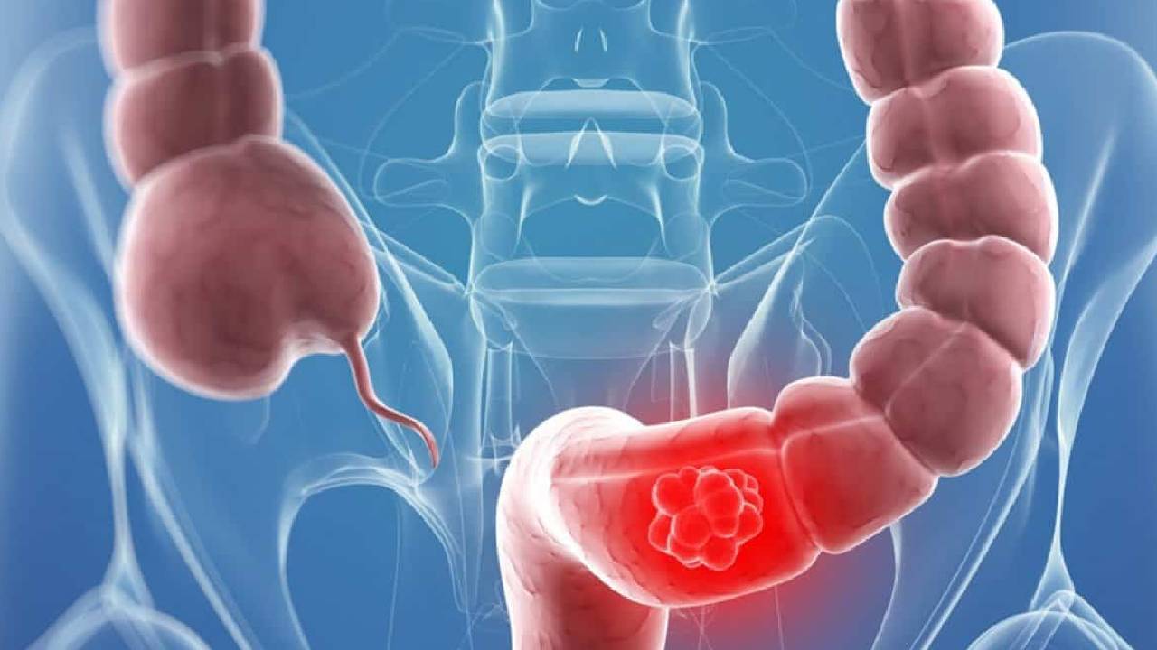 طريقة جديدة لعلاج القولون العصبي في المنزل بدون أدوية